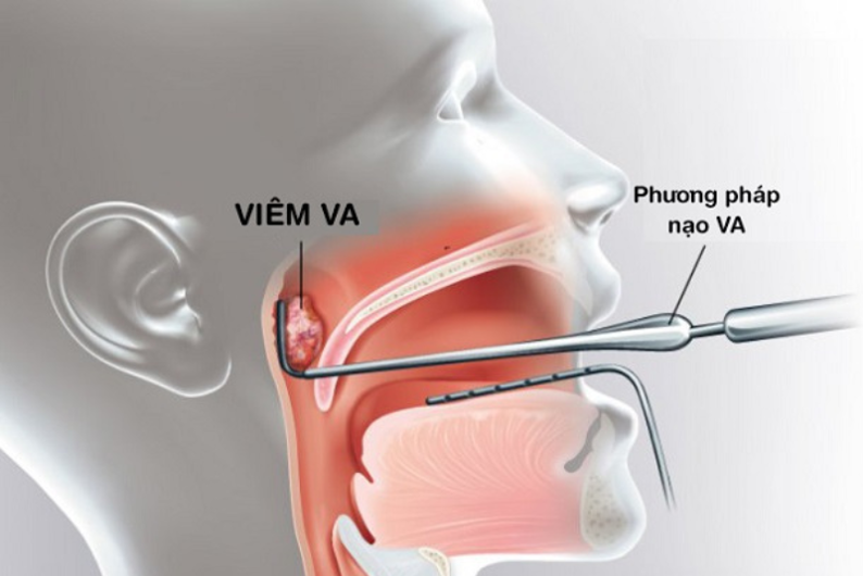 Trẻ bị viêm VA có sao không?