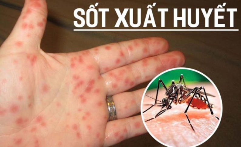 Sốt xuất huyết: triệu chứng, nguyên nhân và cách điều trị