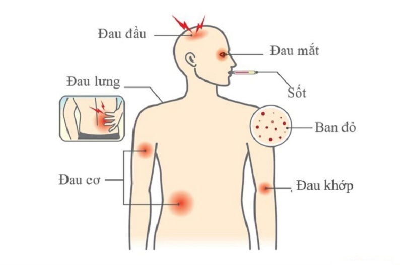 Sốt xuất huyết: triệu chứng, nguyên nhân và cách điều trị