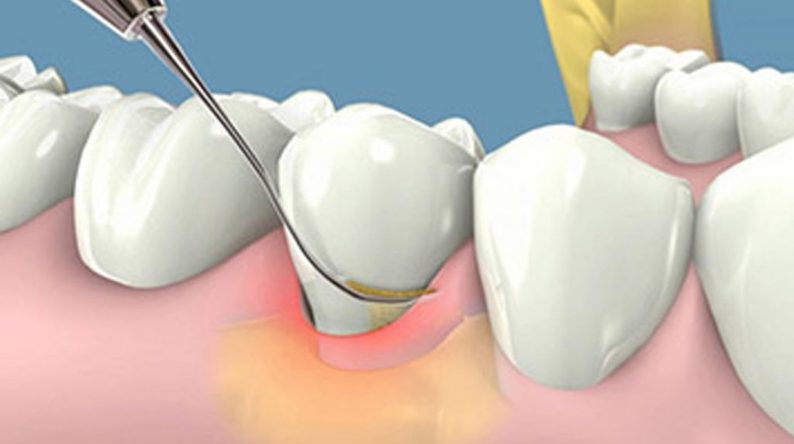 Lấy vôi răng có làm trắng răng không?