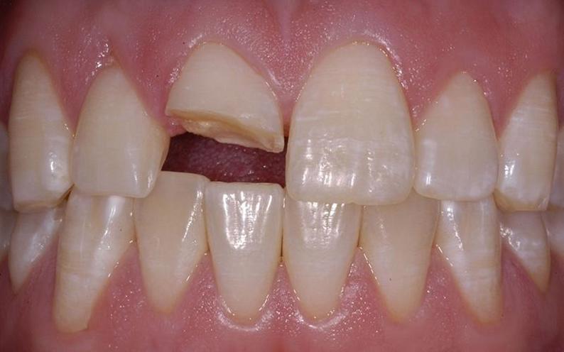 Tẩy trắng răng có làm hư men răng không?
