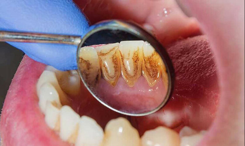 Lấy vôi răng có làm trắng răng không?