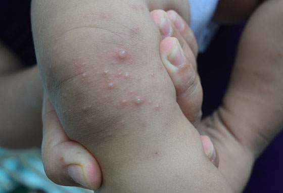 Bộ Y Tế Công Bố Danh Sách Dịch Bệnh Nổi Bật Và Cách Phòng Ngừa