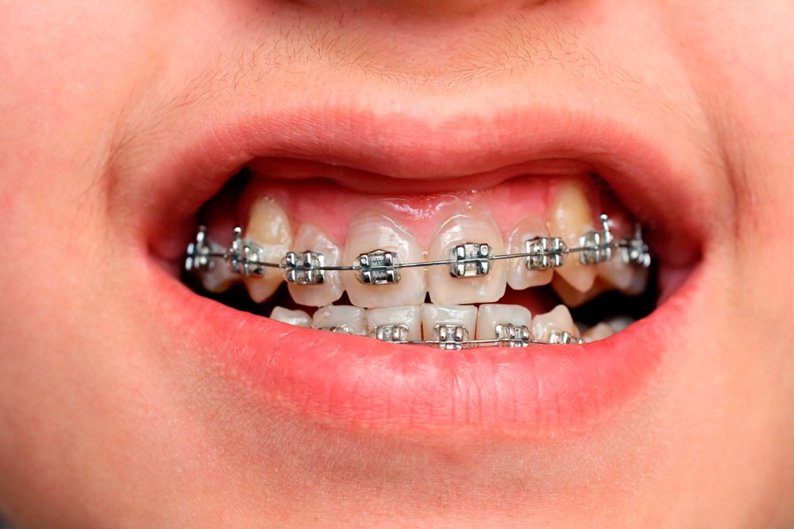 Sau khi niềng răng xong có bị hở lợi không?
