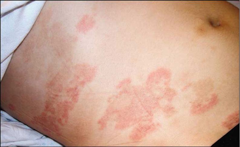 5 Bệnh Thường Gặp Trong Ngày Mưa Bão Nên Lưu Ý