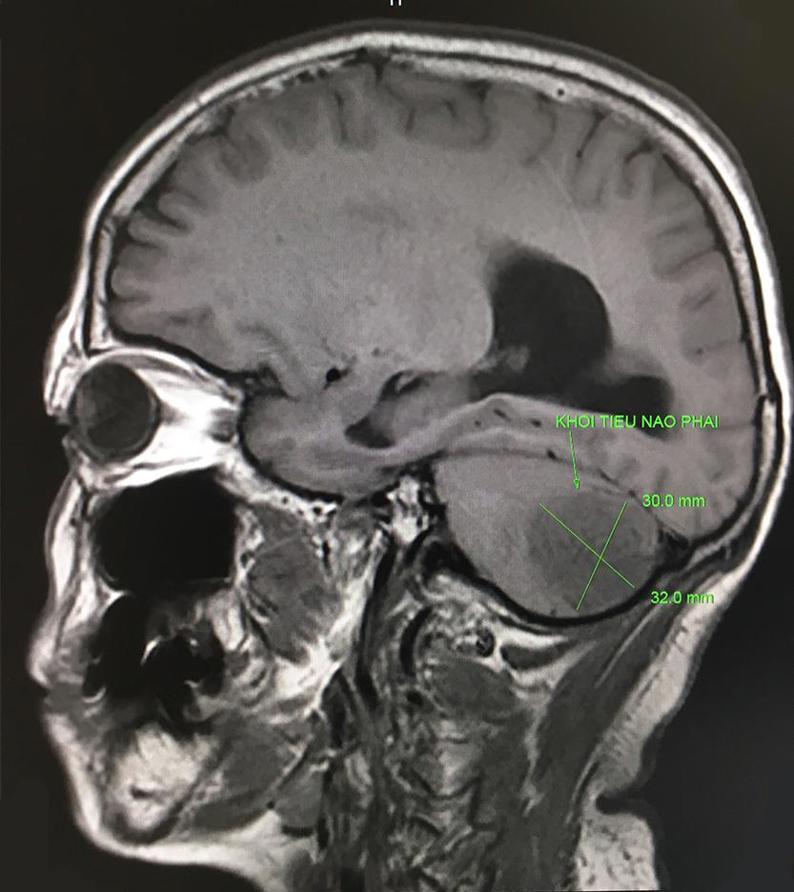 Chụp MRI biết được những bệnh gì?