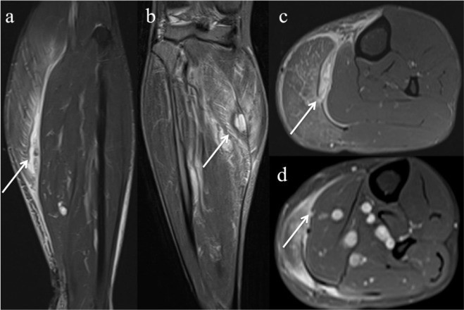 Chụp MRI biết được những bệnh gì?