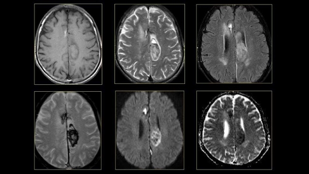 Chụp MRI biết được những bệnh gì?