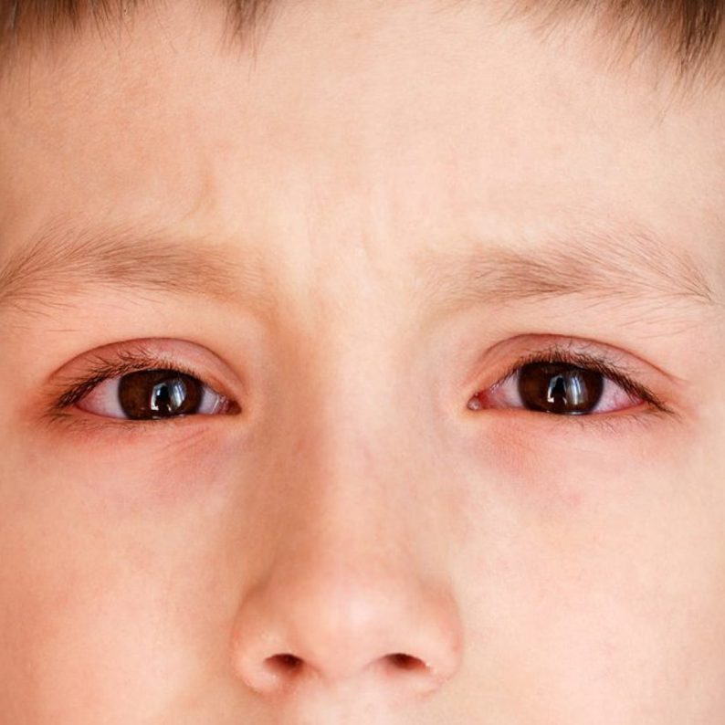 Đau mắt đỏ ở trẻ có cần phải nhập viện?