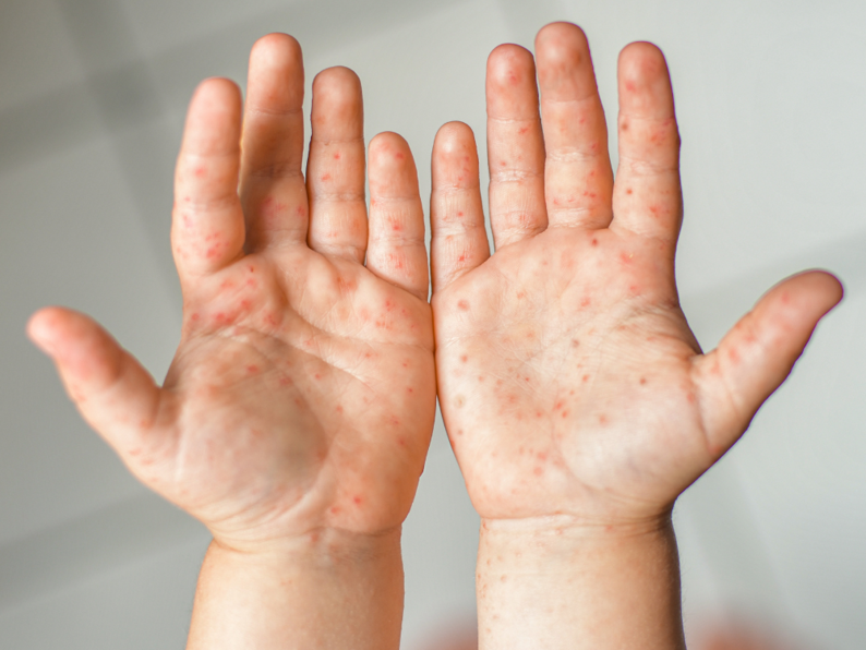 Hình Ảnh Bệnh Tay Chân Miệng Ở Trẻ Em  Cha Mẹ Cần Lưu Ý