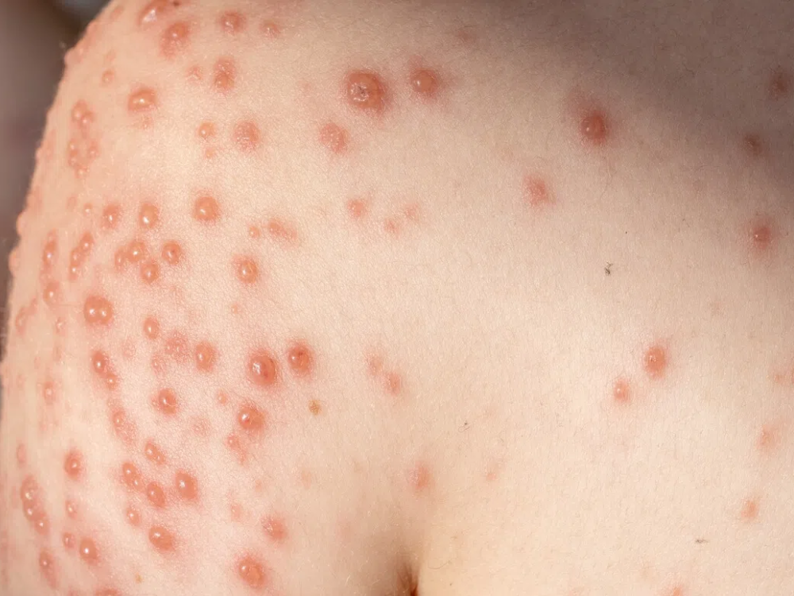 Hình Ảnh Bệnh Tay Chân Miệng Ở Trẻ Em  Cha Mẹ Cần Lưu Ý