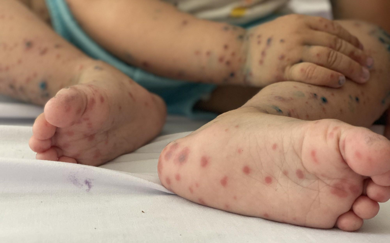 Hình Ảnh Bệnh Tay Chân Miệng Ở Trẻ Em  Cha Mẹ Cần Lưu Ý