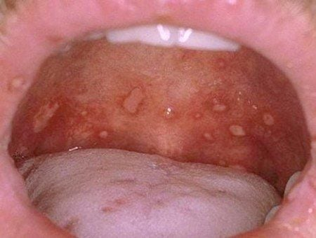 Hình Ảnh Bệnh Tay Chân Miệng Ở Trẻ Em  Cha Mẹ Cần Lưu Ý