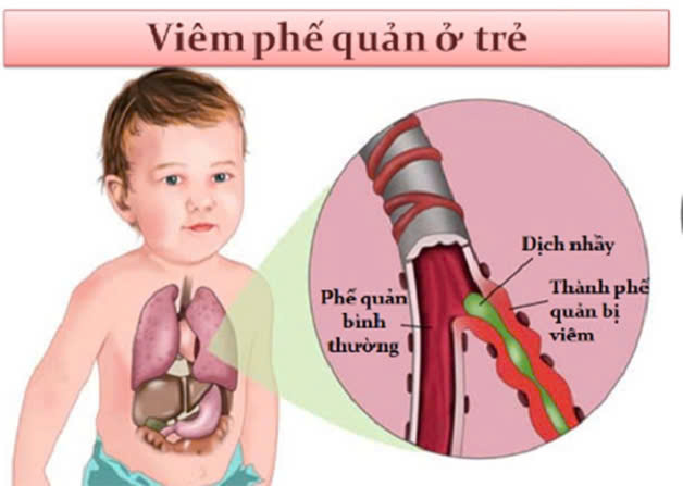 Trẻ bị viêm phế quản khi nào cần nhập viện?