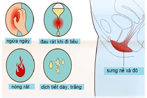 Viêm âm đạo dai dẳng mãn tính 