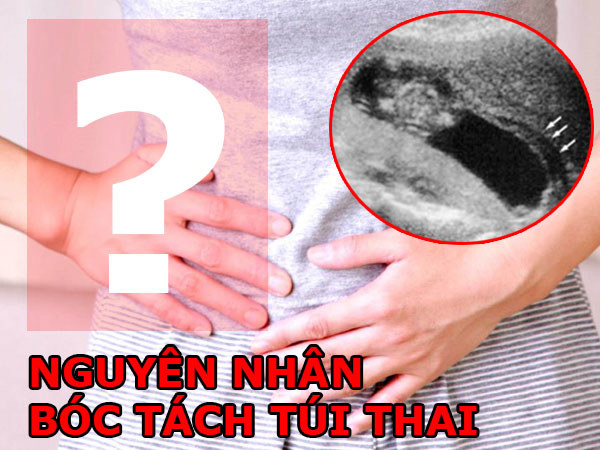 Hiện tượng thai bị bóc tách 10%