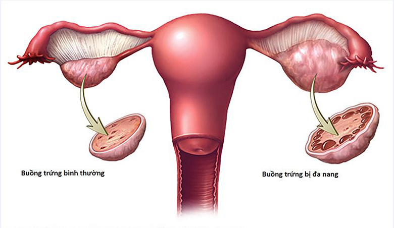 Buồng trứng đa nang có con được không?