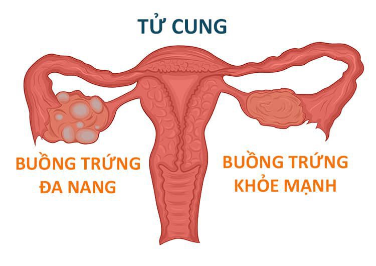 Buồng trứng đa nang có con được không?