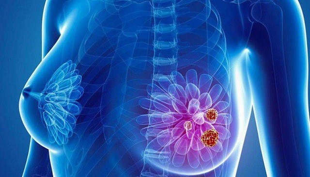 Những dấu hiệu sớm cảnh báo ung thư vú