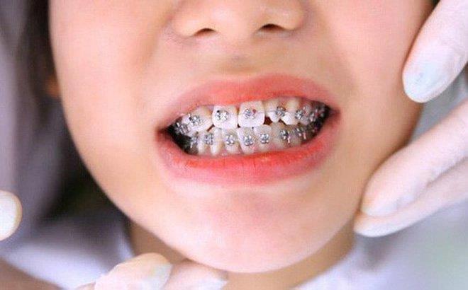 Những trường hợp nào cần niềng răng?