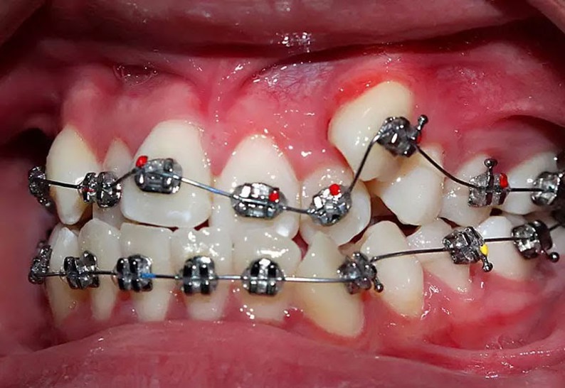 Những trường hợp nào cần niềng răng?