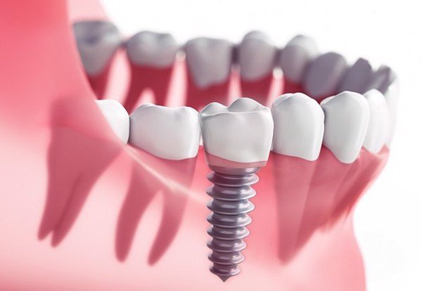 Những điều cần biết khi trồng răng Implant
