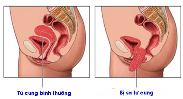 Dấu hiệu nhận biết sa tử cung sau sinh