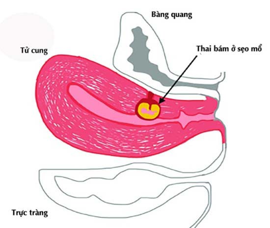 Thai bám ở sẹo mổ lấy thai là gì?