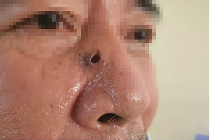 TP. HCM: Lõm mũi, biến dạng mặt vì căn bệnh "hiểm" liên quan đến nắng nóng