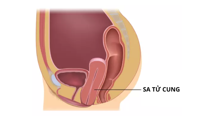 Cách nhận biết sa tử cung bằng tay