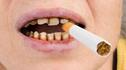 Răng ố vàng là bệnh gì? Nguyên nhân và cách chăm sóc