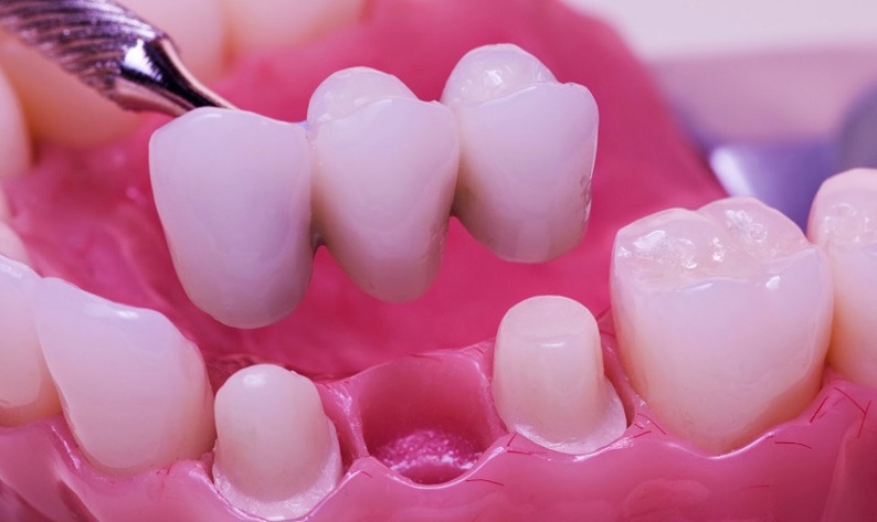 Làm cầu răng hay cấy ghép implant khi bị mất răng?