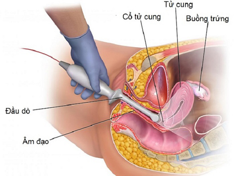 5 điều cần biết về thụ tinh ống nghiệm (IVF)