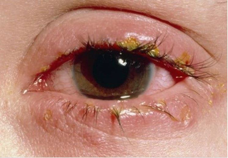 Cách nhận biết bệnh đau mắt đỏ