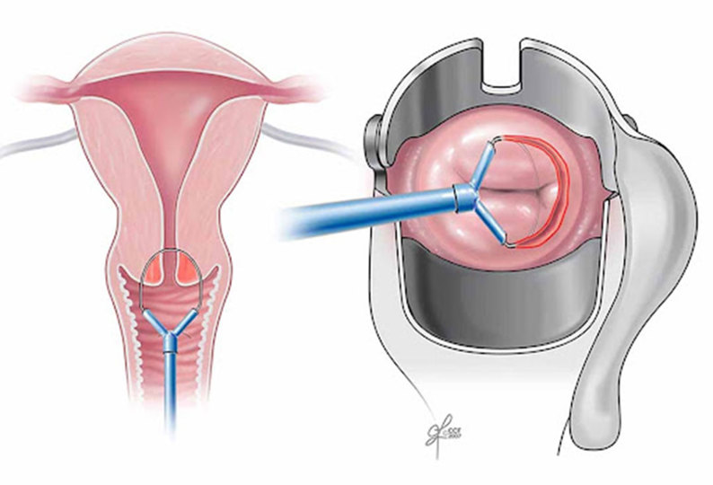 Trường hợp nào được chỉ định làm khoét chóp cổ tử cung?