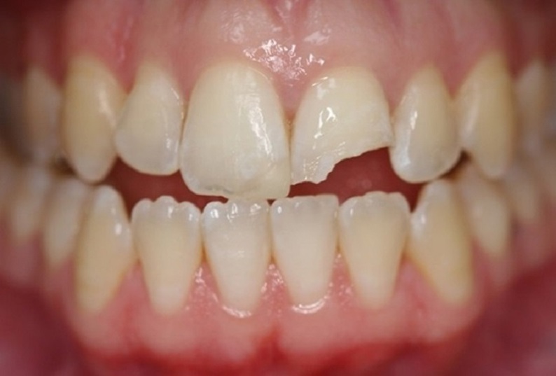 Vì sao cao răng cứng và rất khó lấy ra?