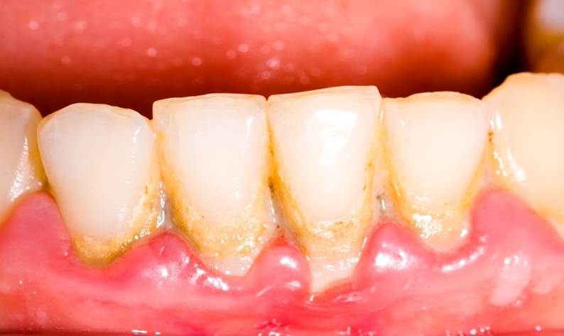 Vì sao cao răng cứng và rất khó lấy ra?