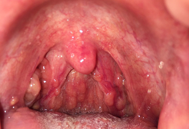 Cuống lưỡi nổi mụn trắng là bệnh gì?