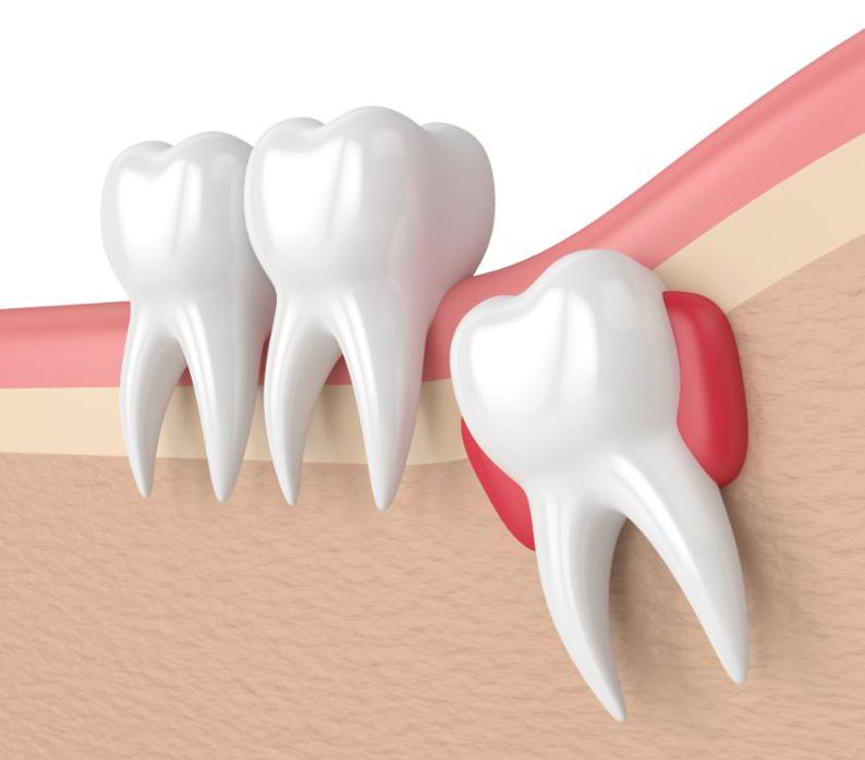 Nhổ răng khôn có ảnh hưởng dây thần kinh không?