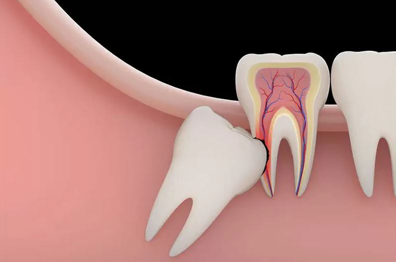 Nhổ răng khôn có ảnh hưởng dây thần kinh không?