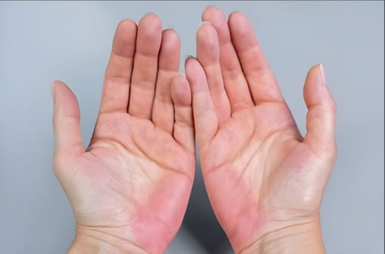 'Bàn tay bệnh gan' có dấu hiệu gì?
