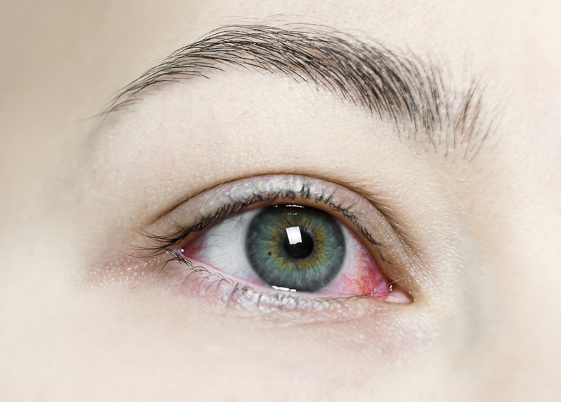 Bệnh đau mắt đỏ bao lâu sẽ khỏi?