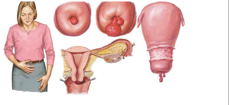 Cắt Polyp tử cung