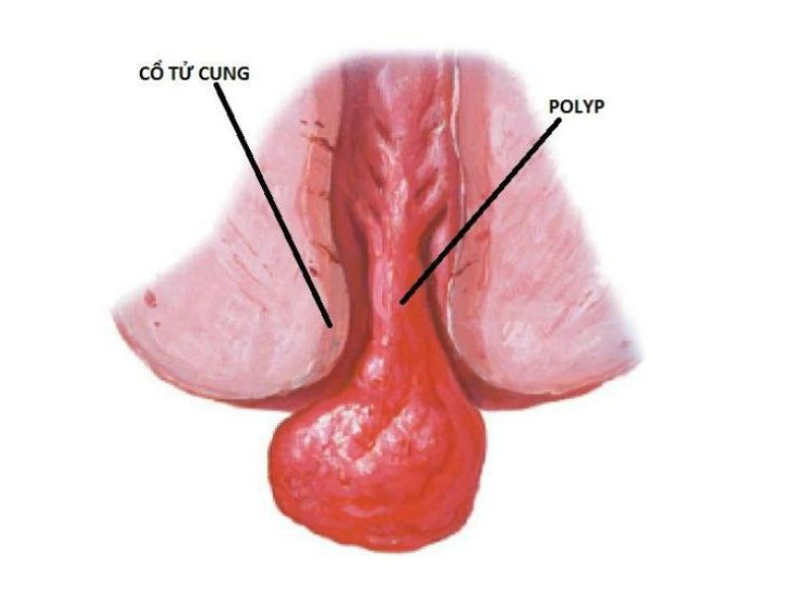 Cắt Polyp tử cung