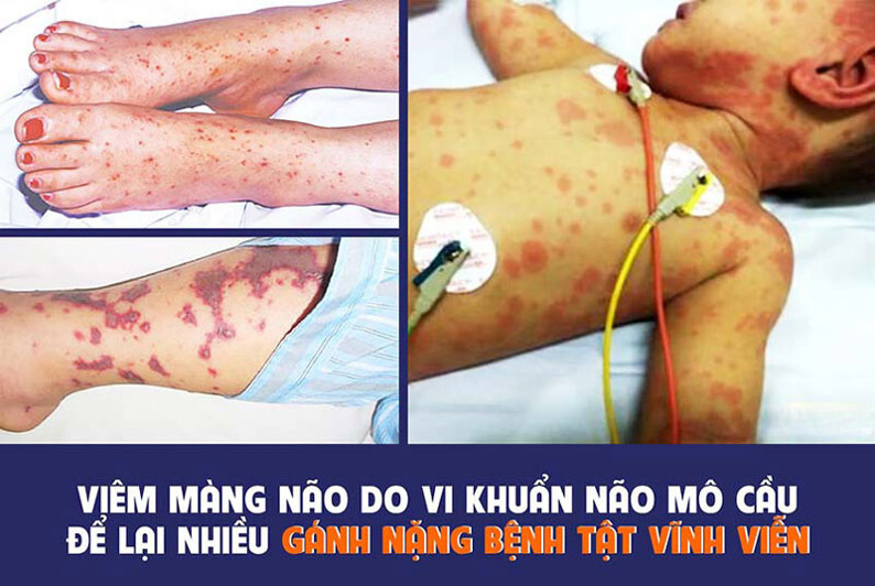 Phân Biệt Dấu Hiệu Não Mô Cầu Và Phát Ban Thông Thường