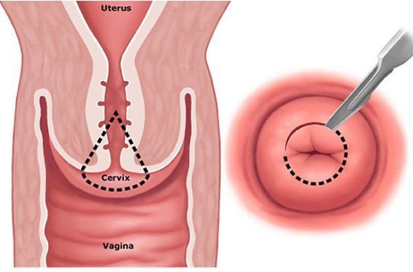 Khoét chóp cổ tử cung có ảnh hưởng đến khả năng sinh sản?