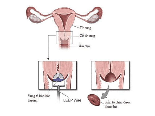 Khoét chóp cổ tử cung có ảnh hưởng đến khả năng sinh sản?