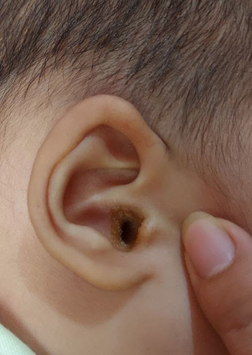 Nguyên nhân, triệu chứng bệnh viêm tai giữa 