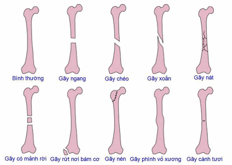 Triệu chứng gãy xương có gì đặc biệt?