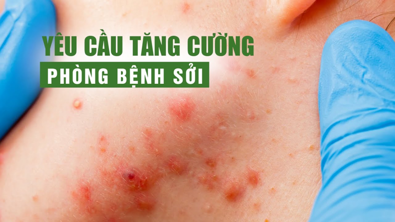 Phòng ngừa bệnh sởi: bảo vệ trẻ trẻ trước sự tấn công của sởi